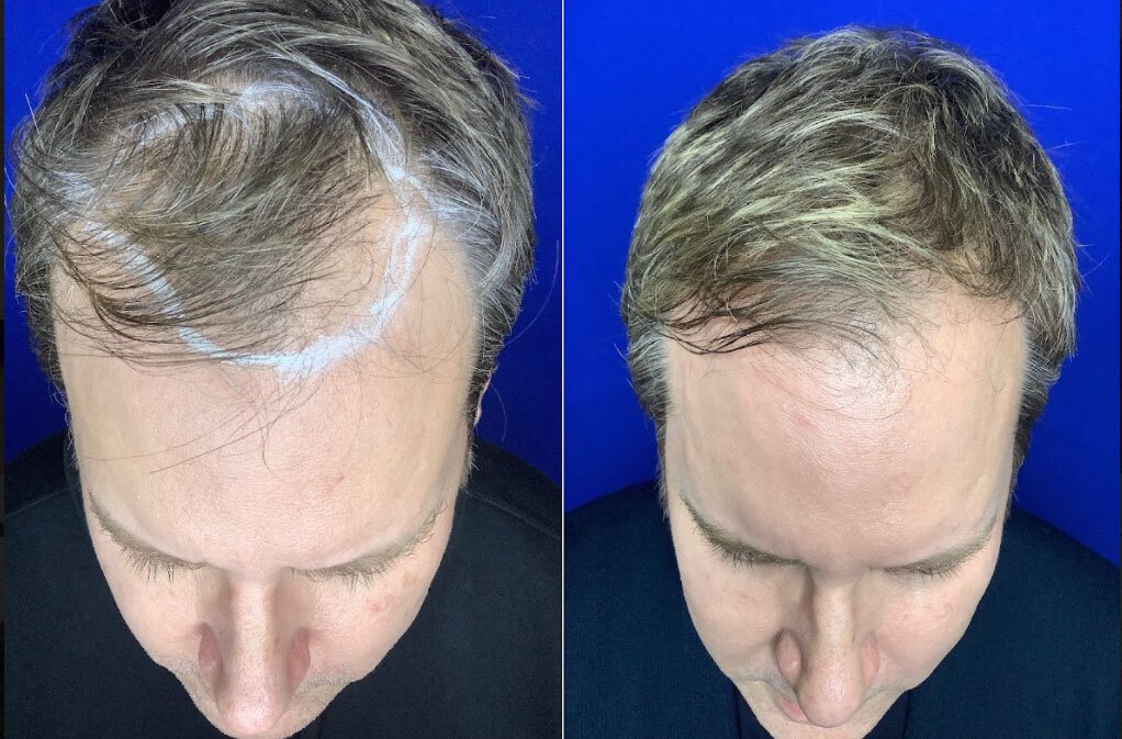 Hair Regrowth from Exosome Treatment
